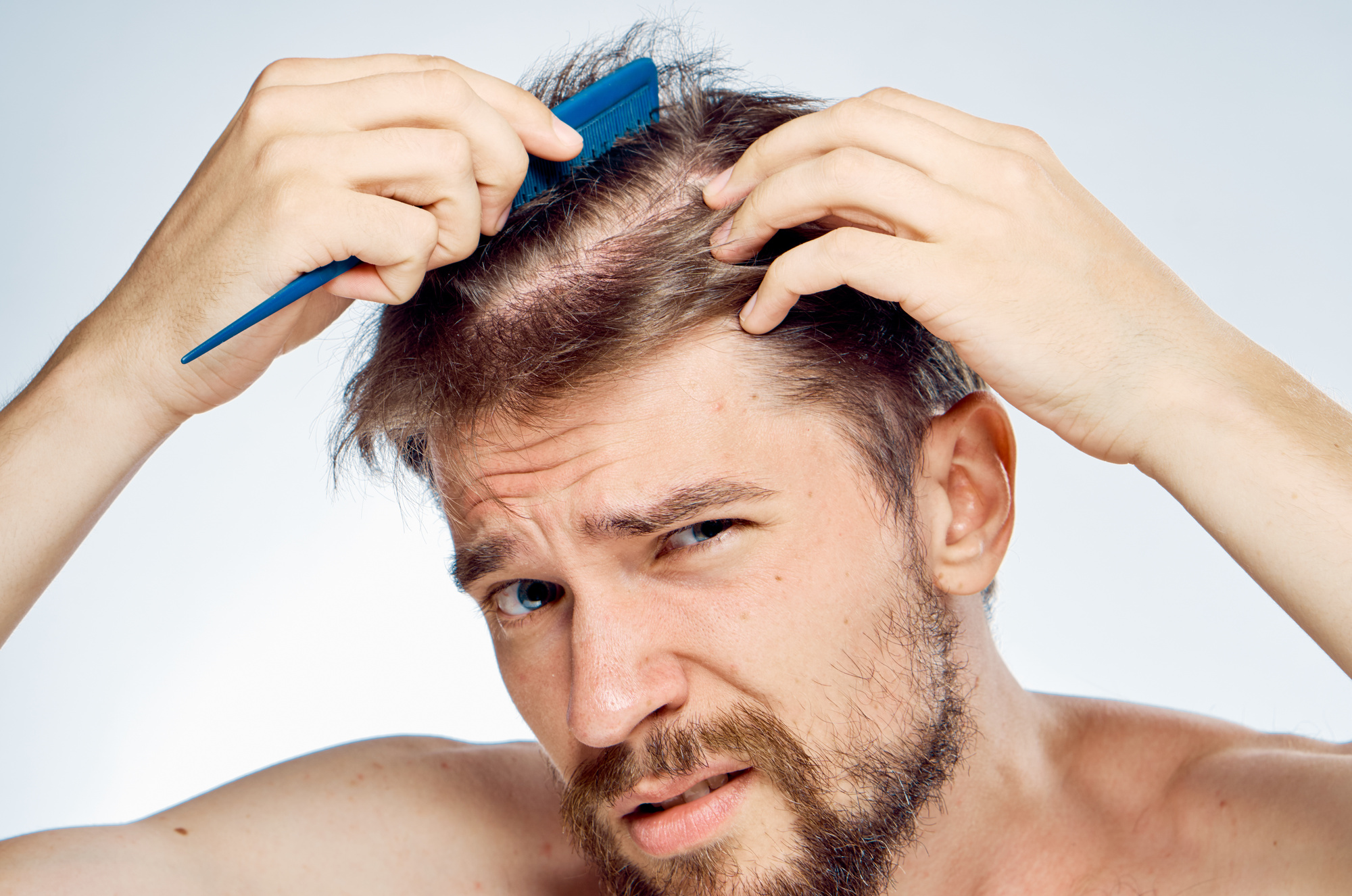 11 Common Signs Of Male Pattern Baldness In Men