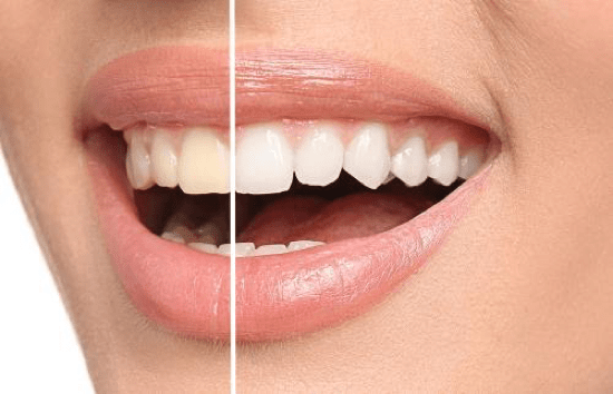 Home Teeth Whitening Kit: Everything You Need to Know | Oaks Dental Korea