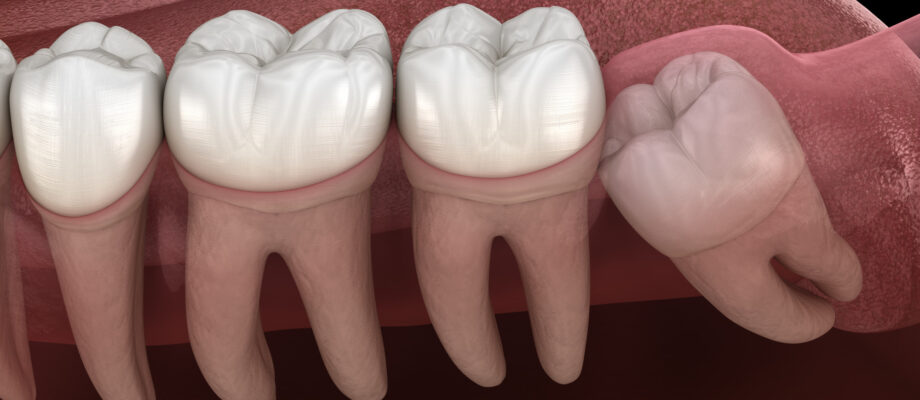 What Is an Impacted Tooth? Causes, Symptoms, and Treatment