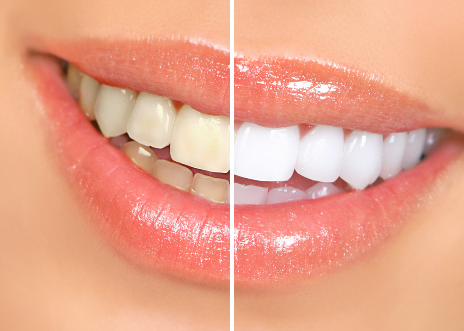 How to Fix Stained Teeth