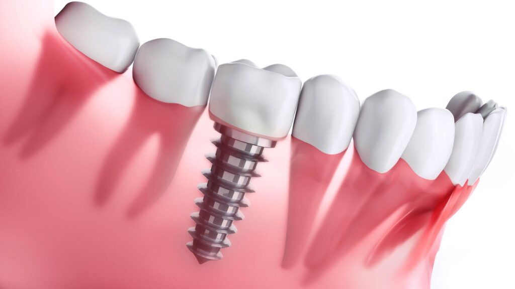 What Makes Implant Dentistry Different From Traditional Dentures | My Zeo 