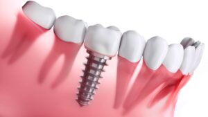 What Makes Implant Dentistry Different From Traditional Dentures | My Zeo 