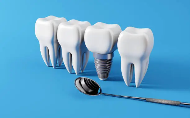 5 Benefits Of Choosing Dental Implants Over Traditional Options | My Zeo 