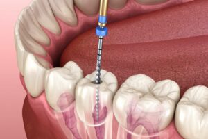 Why Root Canal Therapy Is Often Better Than Extraction | My Zeo