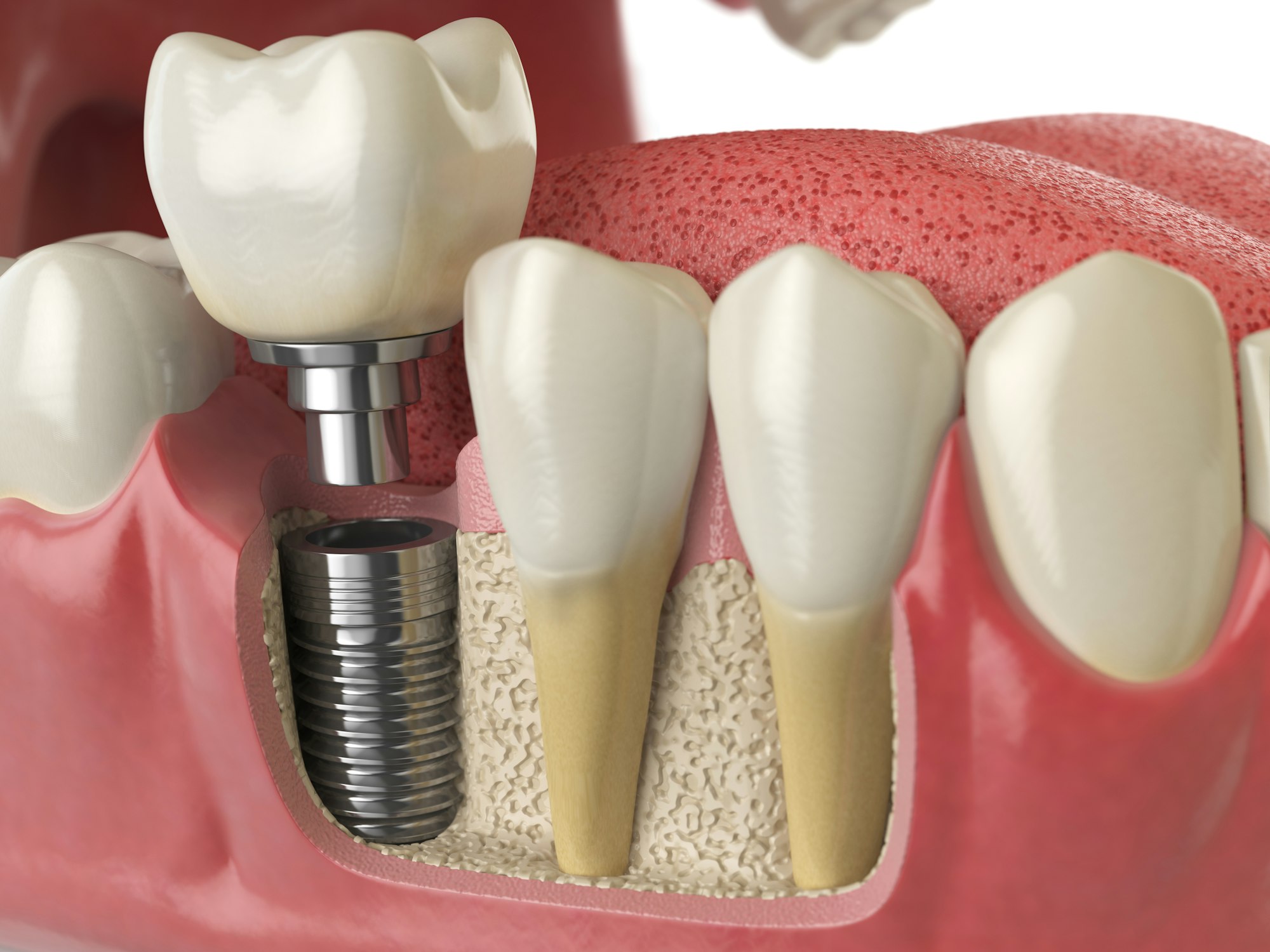 3 Advantages of Choosing a Specialist for Implant Placement | My Zeo 3 advantages of choosing a specialist for implant placement | my zeo