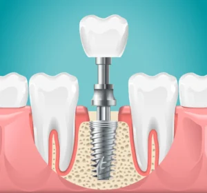 Dental implant diagram showing a titanium screw anchored in the jawbone with a prosthetic tooth on top